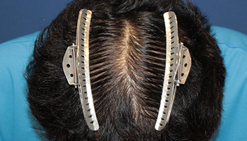 頭頂部の自毛植毛症例写真 50代男性 2,500株 治療後