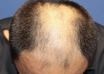 40代 男性 S.N.さん 生え際・前頭部 自毛植毛（MIRAI法） 2,500株の症例（手術前）_01