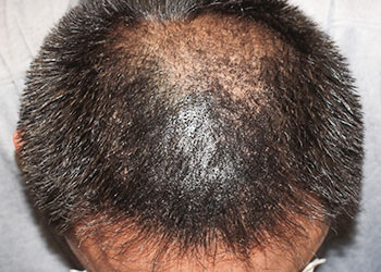 40代 男性 S.N.さん 生え際・前頭部 自毛植毛（MIRAI法） 2,500株の症例（手術後）_01