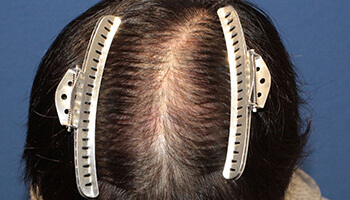 30代 男性 Y.W.さん 頭頂部 自毛植毛（MIRAI法） 1,500株｜自毛植毛の症例の症例（手術前）_01