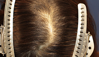 30代 女性 H.R.さん 頭頂部 自毛植毛（MIRAI法） 1,000株｜自毛植毛の症例（手術前）_01