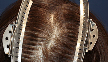 30代 女性 H.R.さん 頭頂部 自毛植毛（MIRAI法） 1,000株｜自毛植毛の症例（手術後）_01