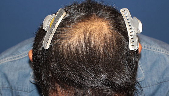 50代 男性 M.Tさん 頭頂部 自毛植毛（MIRAI法） 2,600株｜自毛植毛の症例（手術前）_02