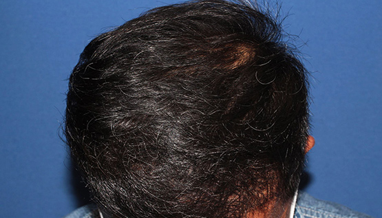 50代 男性 M.Tさん 頭頂部 自毛植毛（MIRAI法） 2,600株｜自毛植毛の症例（手術後）_02