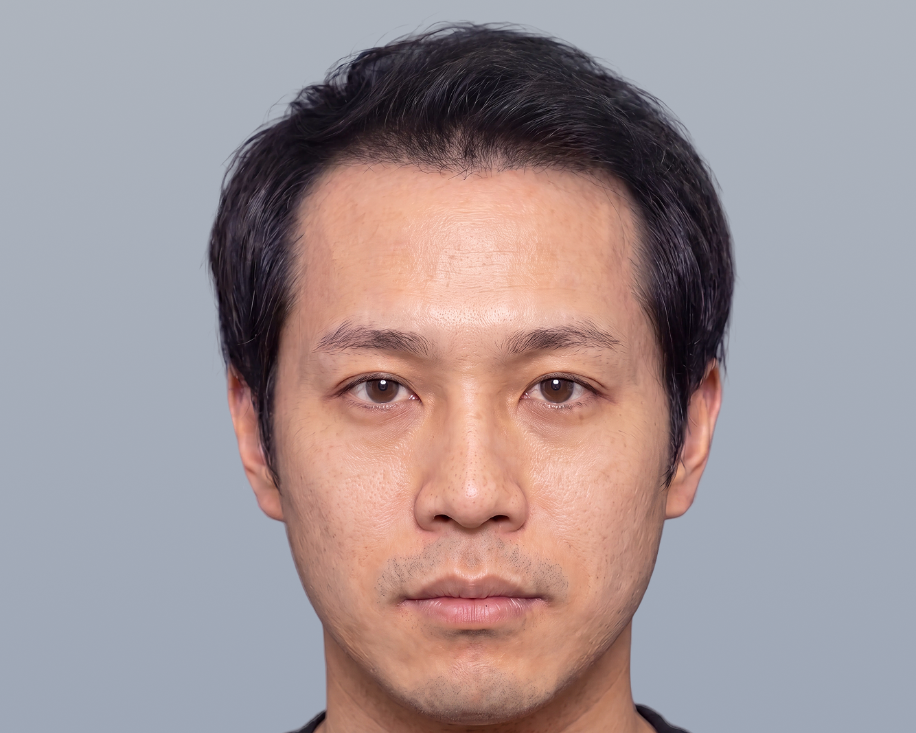 顔全体 After（施術後イメージ）