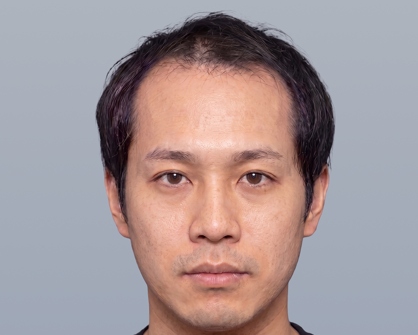顔全体 Before（施術前）