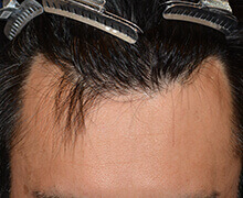 生え際の自毛植毛症例写真 40代男性 1,350株 治療前
