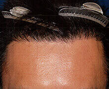 生え際の自毛植毛症例写真 40代男性 1,350株 治療後