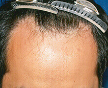 生え際の自毛植毛症例写真 30代男性 1,600株 治療前