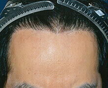 生え際の自毛植毛症例写真 30代男性 1,600株 治療後