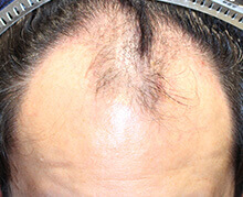 生え際の自毛植毛症例写真 30代男性 2,500株 治療前