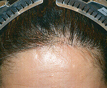 生え際の自毛植毛症例写真 50代女性 1,100株 治療後