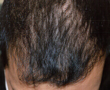 頭頂部の自毛植毛症例写真 30代男性 2,200株 治療後
