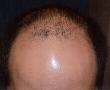 頭頂部の自毛植毛症例写真 30代男性 4,000株 治療前