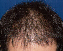 頭頂部の自毛植毛症例写真 30代男性 4,000株 治療後