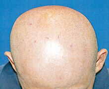 頭頂部の自毛植毛症例写真 50代男性 1,230株 治療前