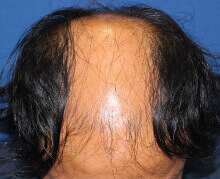 頭頂部の自毛植毛症例写真 30代男性 3,000株 治療前