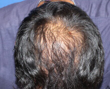 頭頂部の自毛植毛症例写真 30代男性 3,000株 治療後