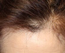 女性の自毛植毛症例写真 50代女性 1,000株 治療前
