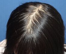 女性の自毛植毛症例写真 40代女性 1,500株 治療後