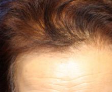 女性の自毛植毛症例写真 70代女性 1,200株 治療前