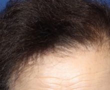 女性の自毛植毛症例写真 70代女性 1,200株 治療後