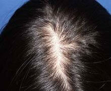 女性の自毛植毛症例写真 30代女性 200株 治療前