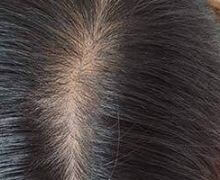 女性の自毛植毛症例写真 30代女性 200株 治療後