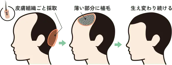皮膚組織ごと採取→薄い部分に移植→生え変わり続ける