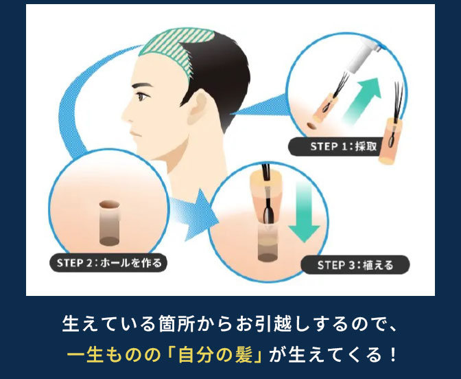 生えている箇所からお引越しするので、一生ものの「自分の髪」が生えてくる！