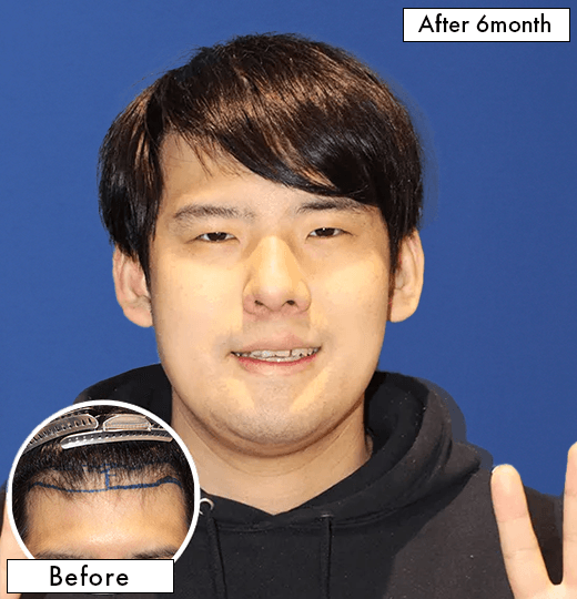 男性 ゆゆうたさんの上半身写真（施術後）
