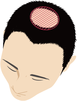 頭頂部のイメージ
